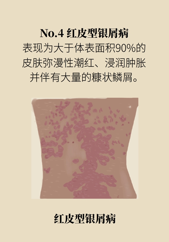 甩不掉的牛皮癣如何防治？3个误区要纠正66 / 作者:UFO爱好者 / 帖子ID:68752
