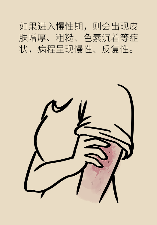 一到夏天痒痒痒！湿疹反反复复，祛湿到底有用吗？333 / 作者:UFO爱好者 / 帖子ID:68514