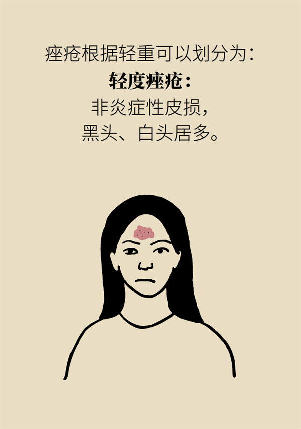 痘痘长个没完！是时候查一查你的食物清单了777 / 作者:UFO爱好者 / 帖子ID:67609