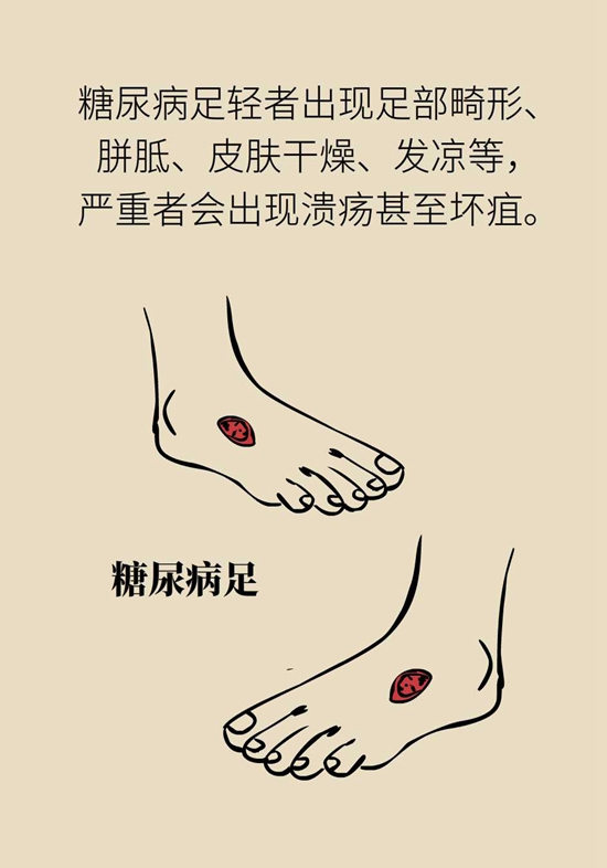 我国老年糖尿病患者超三千万！可怕的并发症必须得防296 / 作者:UFO爱好者 / 帖子ID:72757