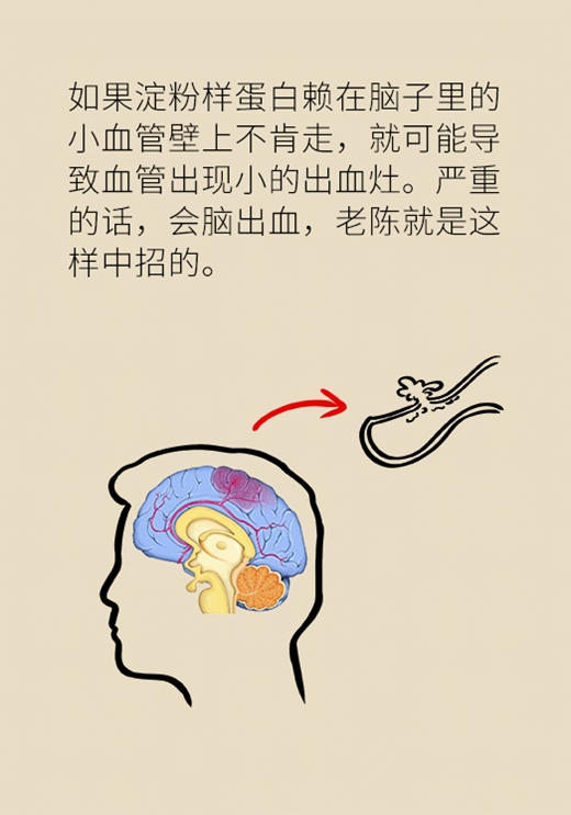 记性变差容易瞌睡，有可能是这种脑出血291 / 作者:UFO爱好者 / 帖子ID:72921