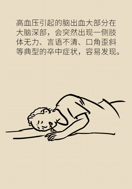 记性变差容易瞌睡，有可能是这种脑出血27 / 作者:UFO爱好者 / 帖子ID:72921