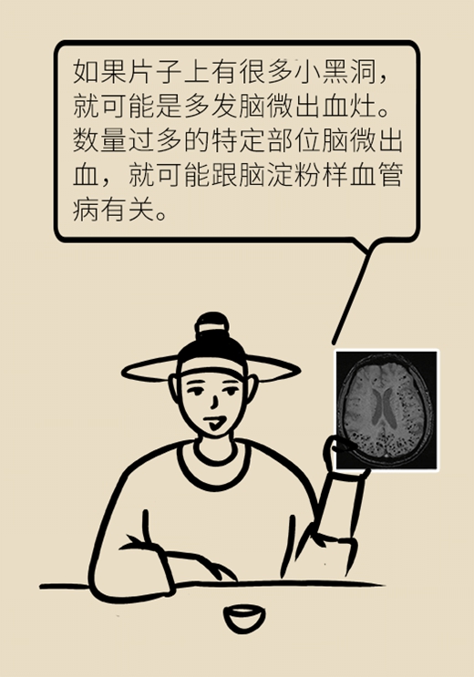 记性变差容易瞌睡，有可能是这种脑出血855 / 作者:UFO爱好者 / 帖子ID:72921