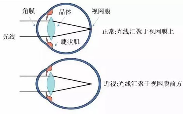 人为什么会近视？有哪些症状？近视眼矫正方法有哪些？255 / 作者:UFO爱好者 / 帖子ID:69533