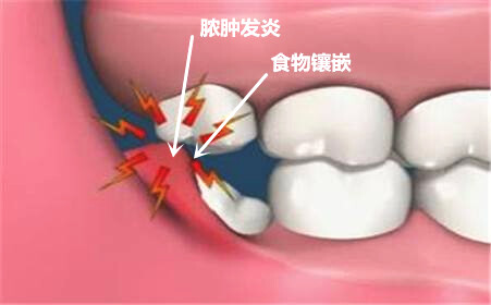 发炎疼痛的智齿为什么不能立刻拔掉 智齿一定要拔吗(多图片)487 / 作者:UFO爱好者 / 帖子ID:70660