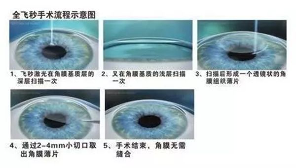 人为什么会近视？有哪些症状？近视眼矫正方法有哪些？701 / 作者:UFO爱好者 / 帖子ID:69533